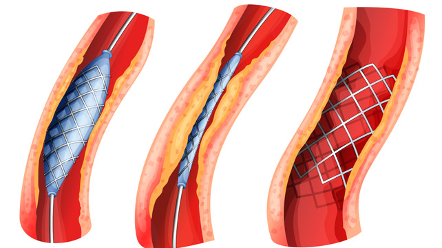 angioplasty