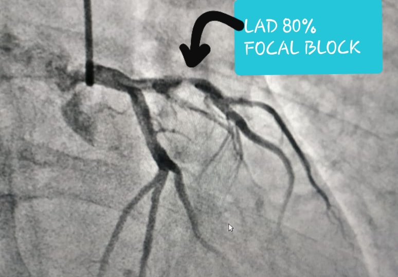 Angiography Test Coronary Angiography Heart Tests Heart Attack