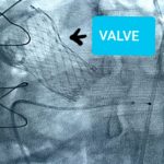 TAVI Treatment