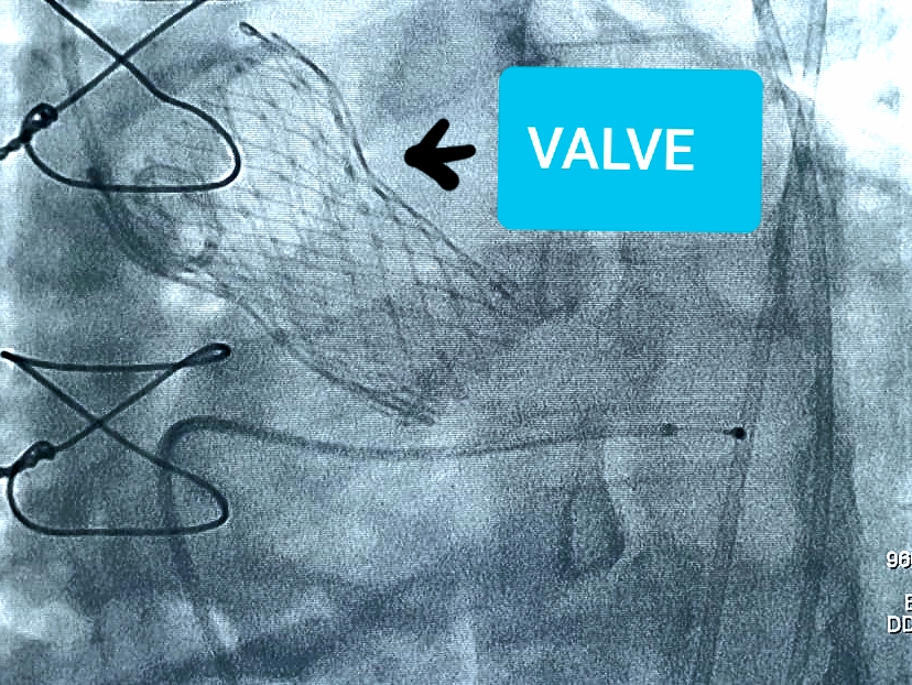 TAVI Treatment