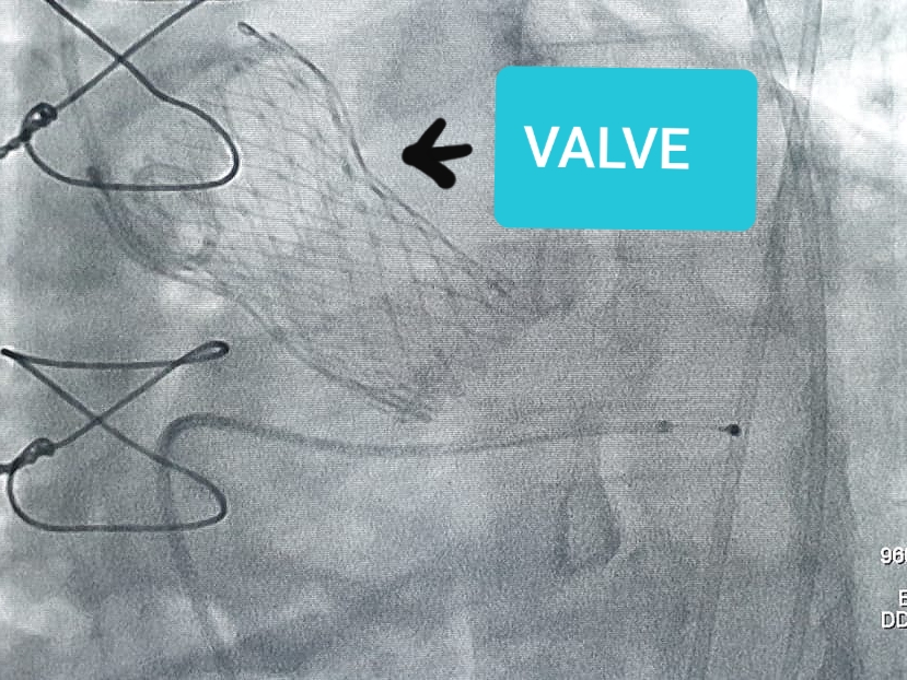 TAVI Procedure