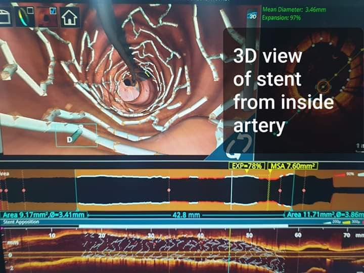 OPTICAL COHERENCE TOMOGRAPHY