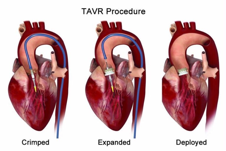 TAVR Procedure