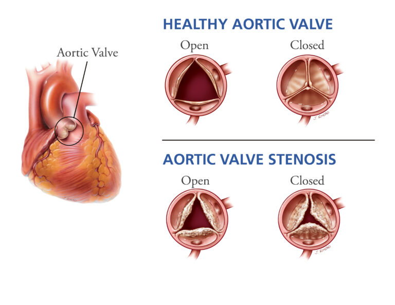 what is tavr and when is it done
