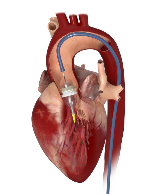 TAVR