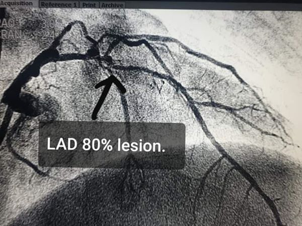 Transcatheter Aortic Valve Implantation