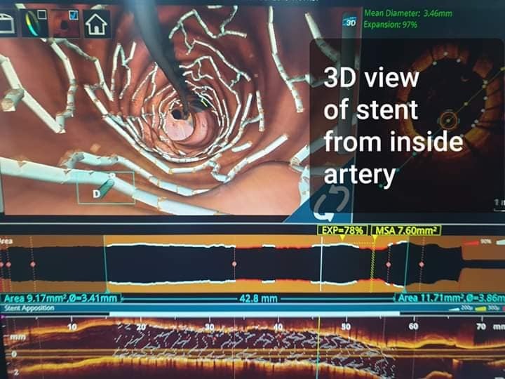 transcatheter aortic valve implantation cost