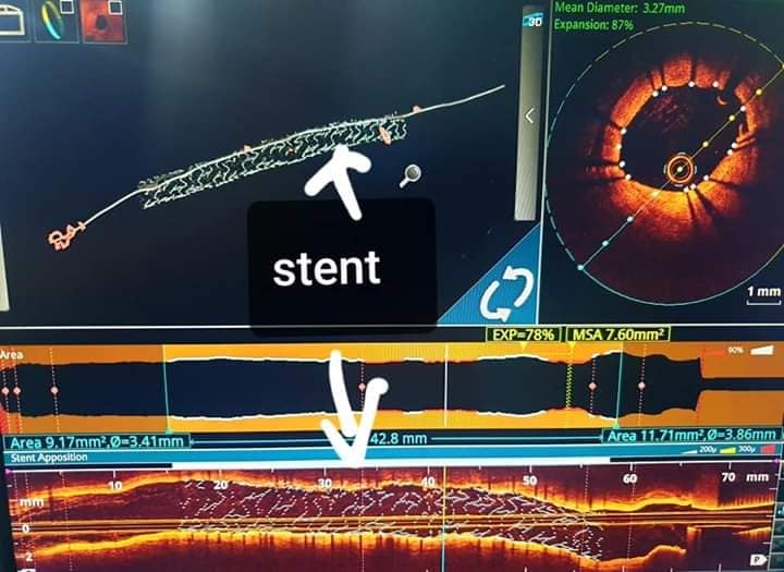 transcatheter aortic valve implantation (tavi)