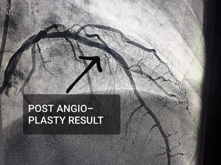 transcatheter aortic valve replacement (tavr) cost in india